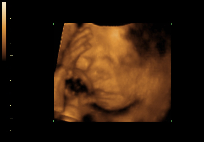 3D ultrasound image at 26 weeks
